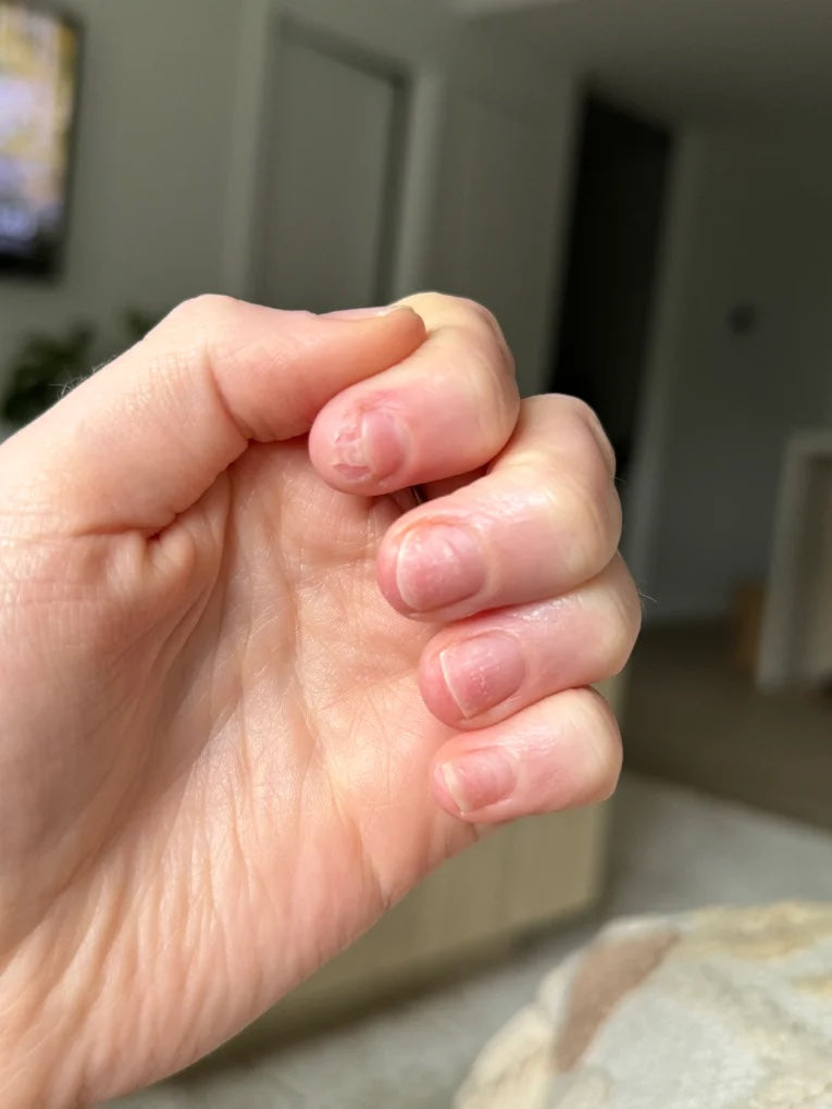 My own nails close up, short and damaged in the first weeks after acrylics